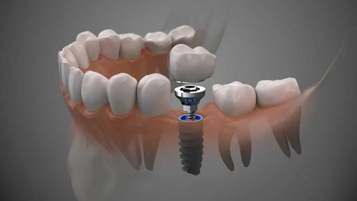 Dental Implants by Smile Bar and Aesthetics