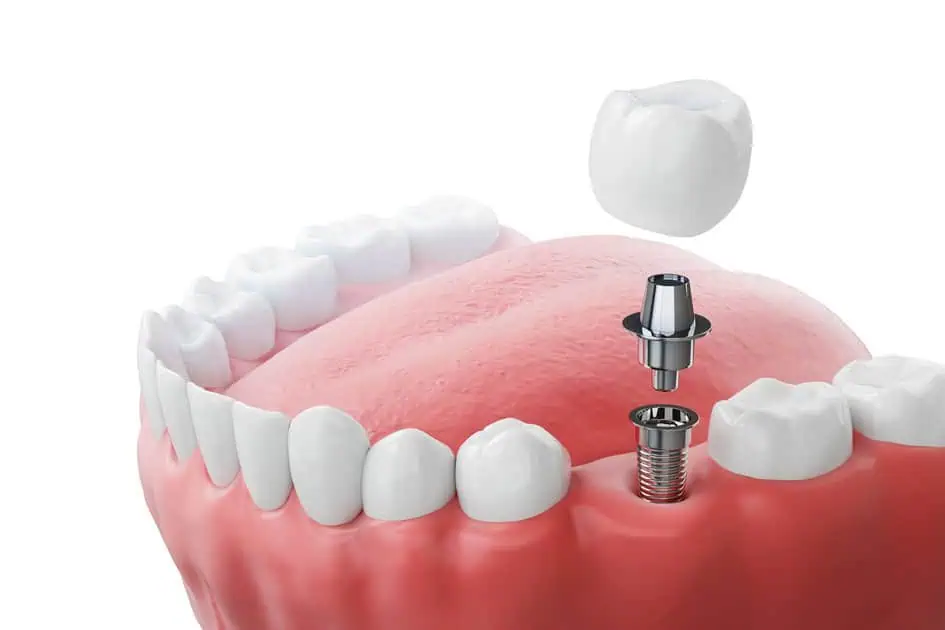 Dental Implants by Smile Bar and Aesthetics LLC in Orland Park, IL