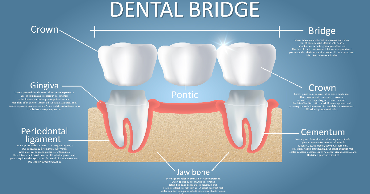 Dental Bridge in Orland Park IL